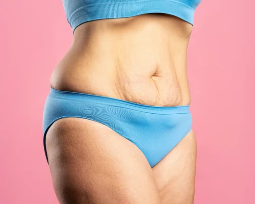 Frau mit schlaffer Haut am Bauch