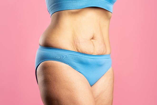 Frau mit schlaffer Haut am Bauch